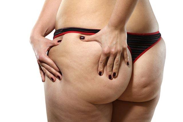 Cellulite