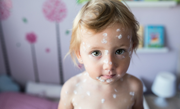 Kind mit Salbe gegen Windpocken im Gesicht